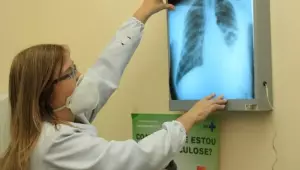 Baixo financiamento mundial ameaça combate à tuberculose