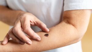 Centro Oncológico promove manhã de prevenção ao câncer de pele no Parque da Cidade, em Mogi 