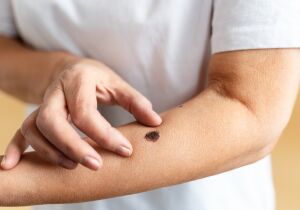 Centro Oncológico promove manhã de prevenção ao câncer de pele no Parque da Cidade, em Mogi 