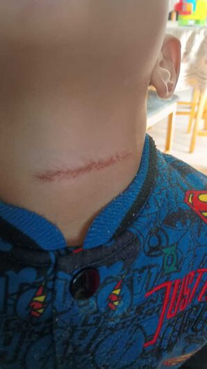Criança sofre corte no pescoço por linha com cerol no quintal de casa em Suzano  