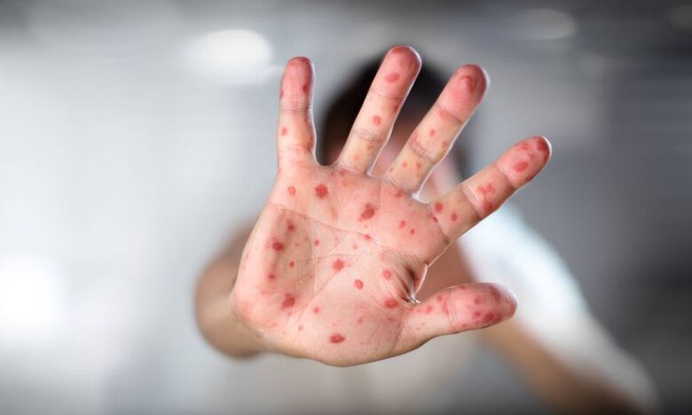 SARAMPO Cidades da região estão em alerta para eventuais casos que possam surgir 