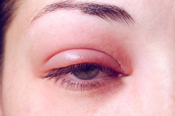 Especialista orienta como aliviar a coceira nos olhos sem colocar a saúde ocular em risco