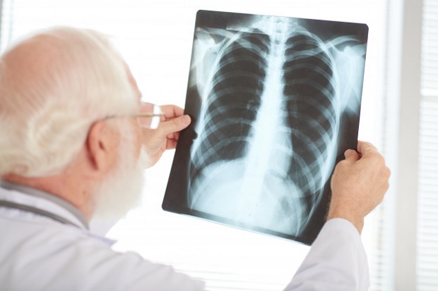 Alto Tietê tem 397 novos casos de tuberculose