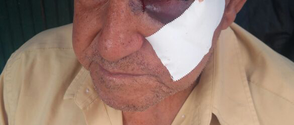Aposentado foi atingido por soco no olho esquerdo